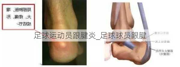 足球运动员跟腱炎_足球球员跟腱